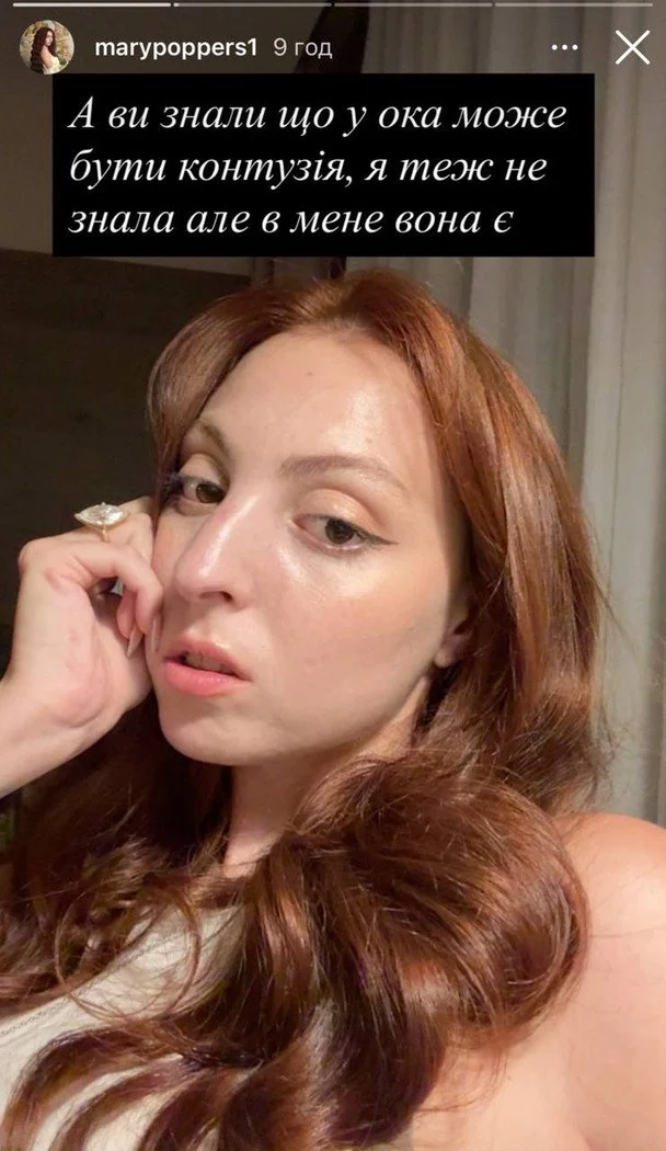 Маша Полякова після ДТП / © instagram.com/marypoppers1