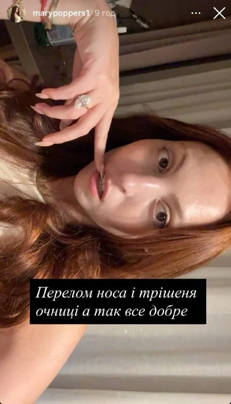 Маша Полякова після ДТП / © instagram.com/marypoppers1