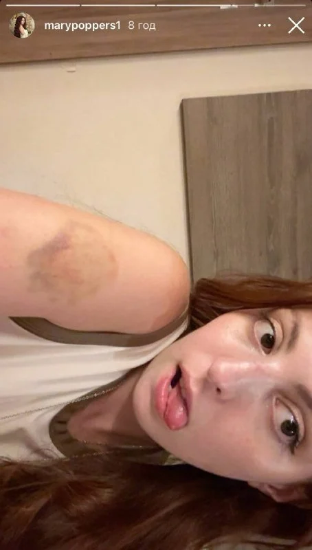 Маша Полякова після ДТП / © instagram.com/marypoppers1